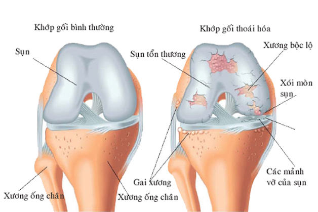 Thoái hóa khớp gối