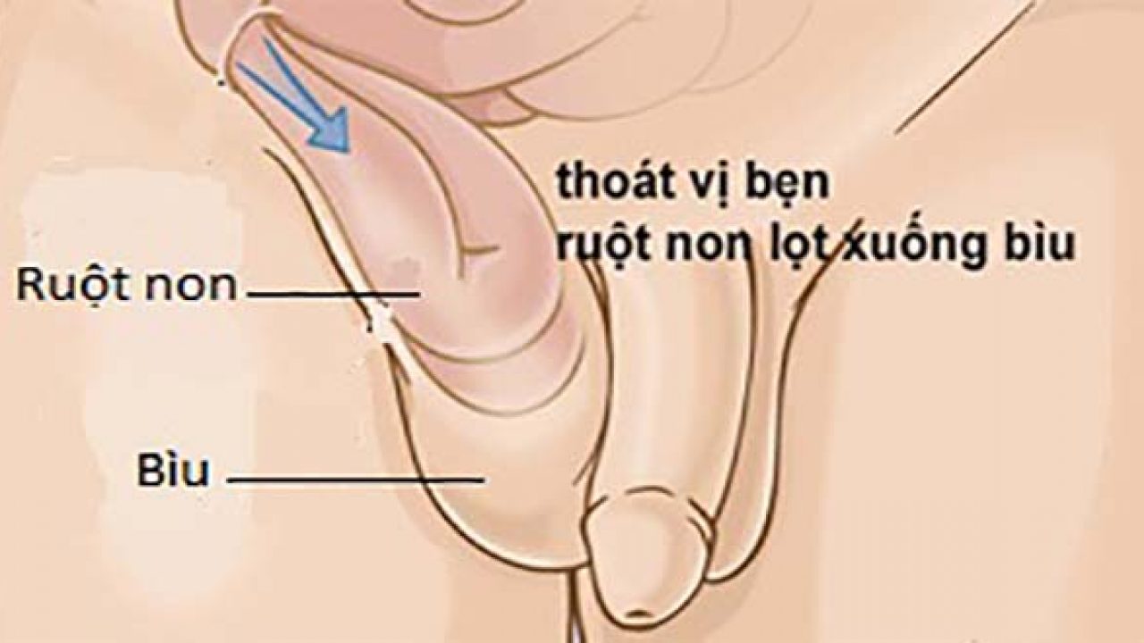 Thoát vị bẹn ở trẻ có dấu hiệu đặc trưng là vùng nhô lên ở vùng bẹn