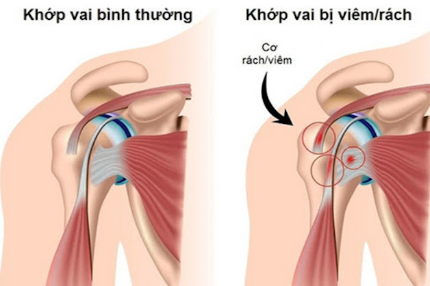 viêm khớp vai và cách điều trị phù hợp