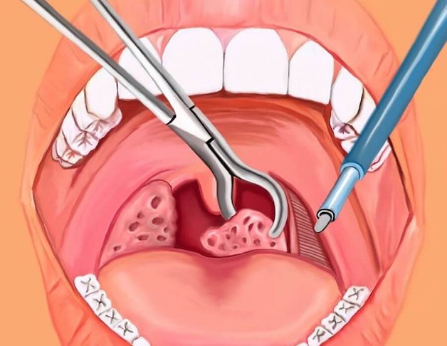 cắt amidan bằng laser có đau không