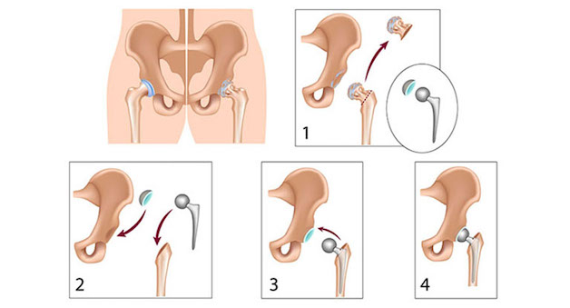 thay khớp háng toàn phần và bán phần là gì