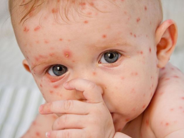 Trẻ sơ sinh bị sởi có thể do người mẹ bị nhiễm virus sởi trong 2 đến 3 tuần cuối của thai kỳ, trong lúc chuyển dạ hoặc sau sinh dẫn đến lây cho trẻ