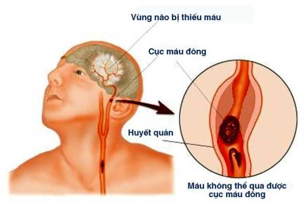Bệnh thiếu máu não còn được gọi với tên khác là thiểu năng tuần hoàn não.