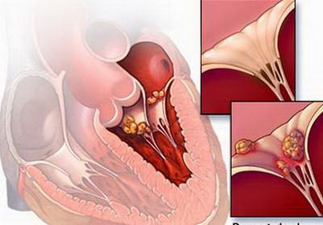 Bệnh thấp tim nếu không được điều trị kịp thời có thể gây ra những biến chứng nghiêm trọng tại tim.