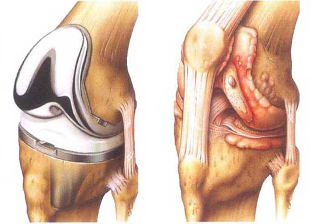 mổ thay khớp gối ở đâu