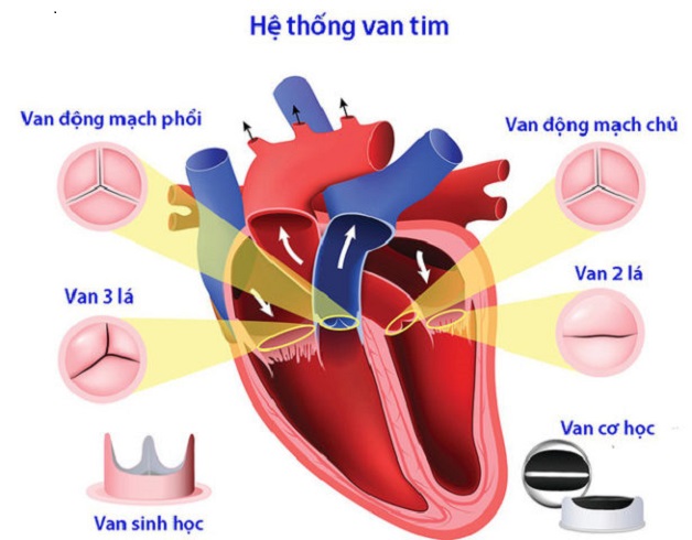Hẹp van động mạch phổi là tình trạng van tim nằm giữa tâm thất phải và động mạch phổi không thể mở được hoàn toàn để tống máu tới động mạch phổi.