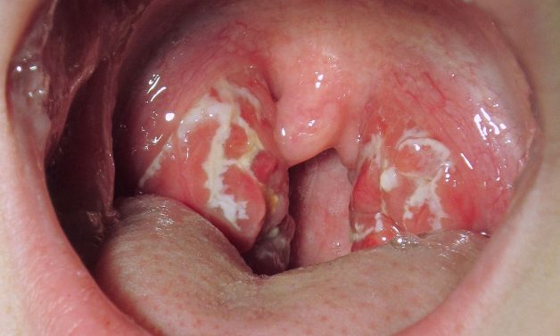 Viêm Amidan gồm 2 loại: Cấp tính và mạn tính. Và mỗi loại sẽ có một cách điều trị khác nhau