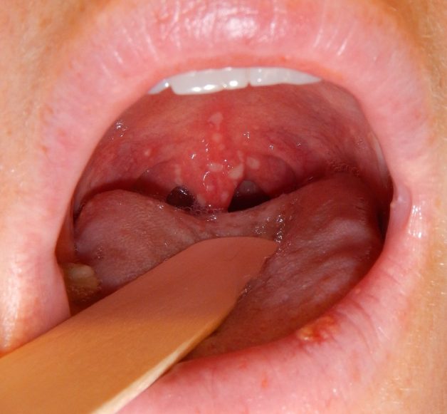 Viêm Amidan hốc mủ