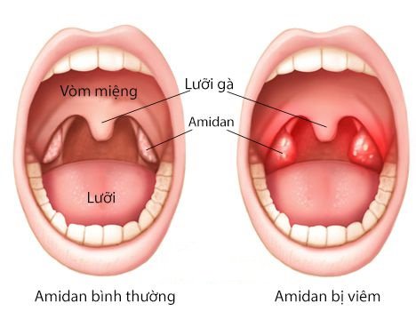 Viêm Amidan là gì