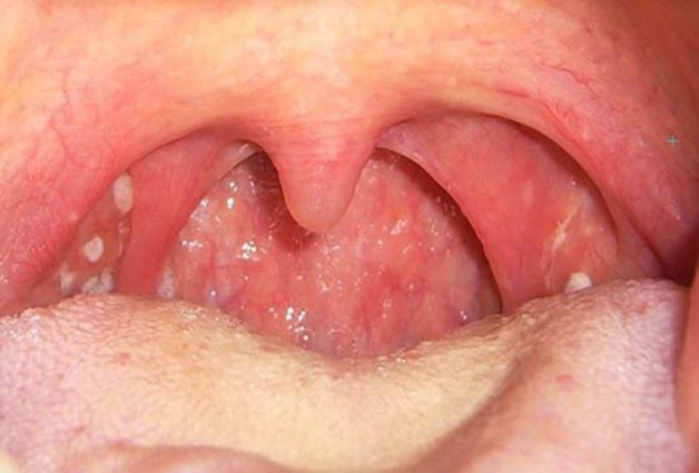 Viêm amidan mãn tính là căn bệnh nhiều người gặp phải