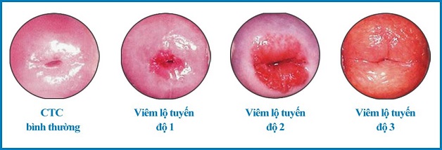 viêm lộ tuyến cổ tử cung có nên đốt không