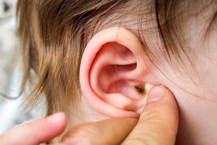 Khi bị viêm ống tai ngoài, trẻ thường bứt tai, tai có mùi hôi và có thể chảy mủ