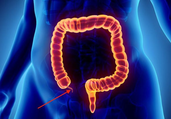Viêm ruột thừa và siêu âm ruột thừa