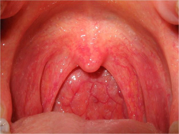 Viêm thanh quản cấp là tình trạng mà niêm mạc thanh quản bị viêm kéo dài dưới 3 tuần, đây là bệnh khá phổ biến ở nước ta
