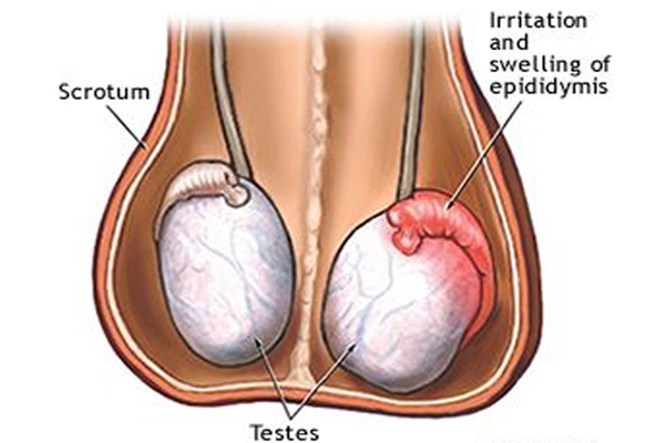 Tiêm tinh hoàn sau quai bị là tình trạng virus quai bị từ tuyến nước bọt lây nhiễm sang tinh hoàn, khi đã xâm nhập thành công, virus sẽ tác động và làm tổn thương tế bào sinh tinh