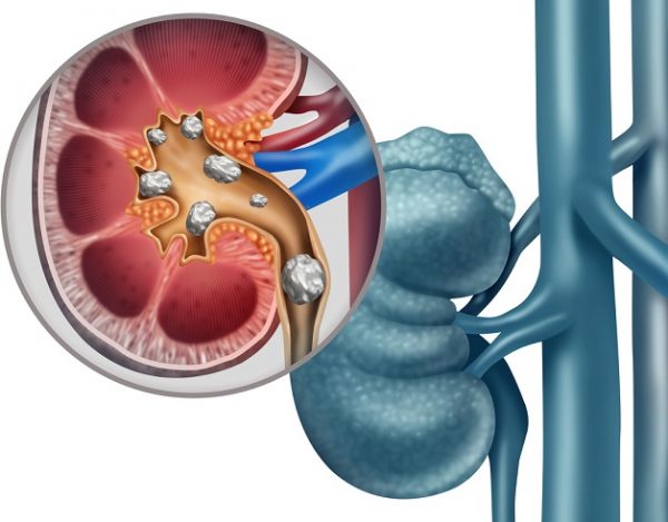 Cách phát hiện sỏi thận cần biết