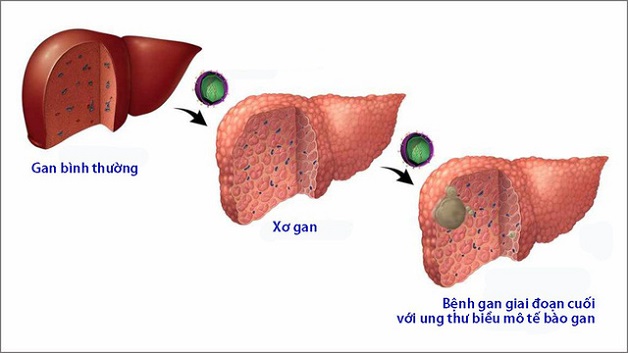 Ung thư gan là biến chứng nguy hiểm của bệnh lý xơ gan, có tiên lượng xấu với tỷ lệ tử vong rất cao