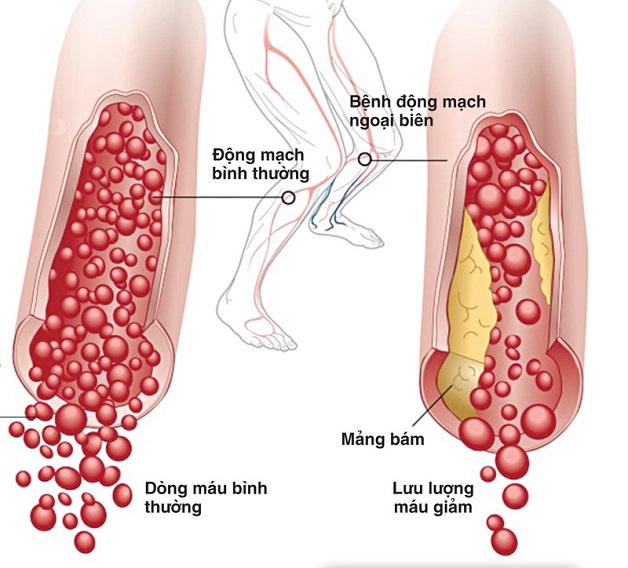 Xơ vữa động mạch chi dưới là hiện tượng tích tụ chất béo ở động mạch chân, làm giảm lượng máu nuôi chi.