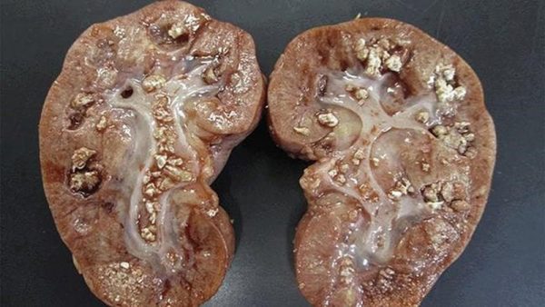 Điều trị sỏi thận nhỏ là gì?