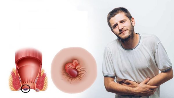 Bệnh trĩ có chữa dứt điểm được không