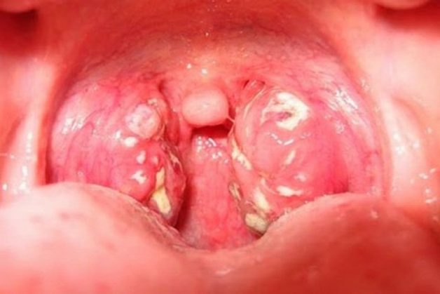 Ở giai đoạn cấp tính, bệnh không quá khó khăn để điều trị. Nhưng khi diễn tiến sang mạn tính, bệnh nhân sẽ phải thực hiên phẫu thuật để loại bỏ ổ viêm