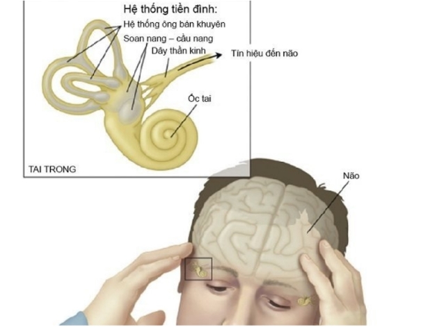 Người có các triệu chứng của bệnh rối loạn tiền đình cần đi khám sớm tại chuyên khoa Nội thần kinh
