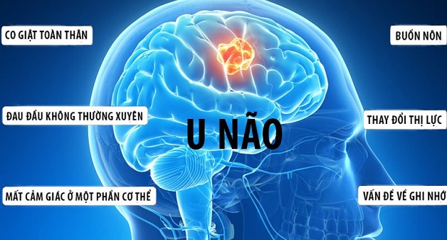 bệnh đau đầu và cách điều trị do nguyên nhân trong não