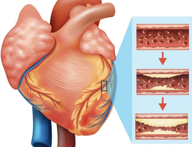 Bệnh mạch vành là tình trạng lòng mạch bị thu hẹp, cản trở quá trình cung cấp máu nuôi dưỡng cơ tim.