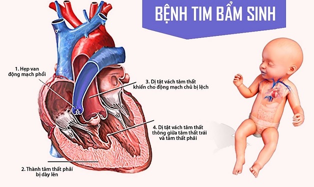 Những khiếm khuyết khi hình thành quả tim ở giai đoạn bào thai làm trẻ sinh ra mắc bệnh tim bẩm sinh.