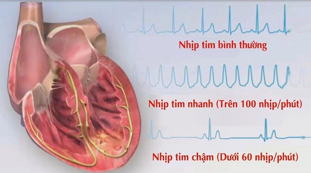Thông thường, nhịp tim dưới 60 nhịp/phút thì được gọi là tim đập chậm.