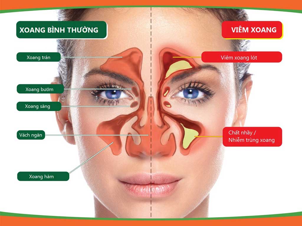 VIÊM XOANG HÀM LÀ DẠNG VIÊM XOANG PHỔ BIẾN NHẤT HIỆN NAY