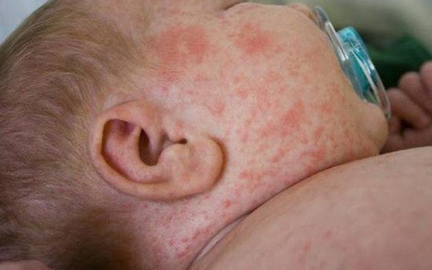 Bố mẹ cần phải theo dõi sát sao khi bé bị sốt xuất huyết