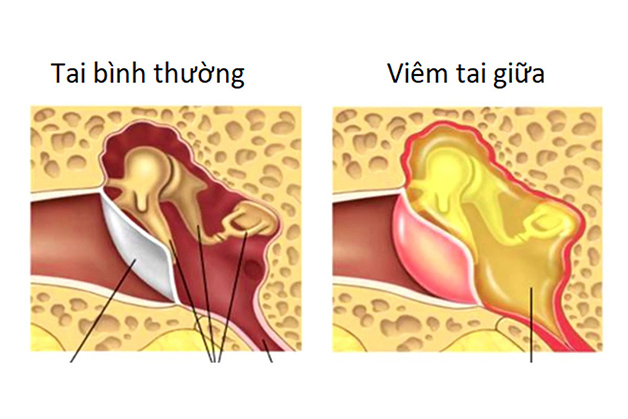 viêm tai giữa cấp tính
