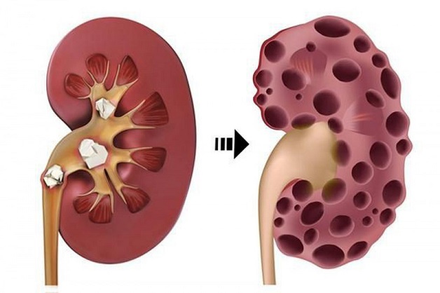 Cách chữa trị sỏi thận cần biết