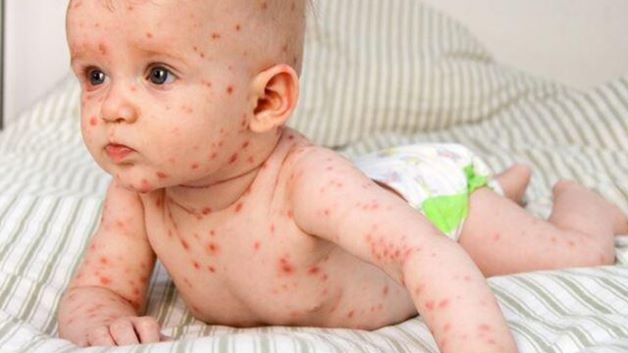 Sởi ở trẻ nhỏ là bệnh lây truyền cấp tính qua đường hô hấp. Bệnh sởi do virus gây ra với các biểu hiện là sốt cao, viêm kết mạc mắt, viêm long đường hô hấp và tiêu hóa