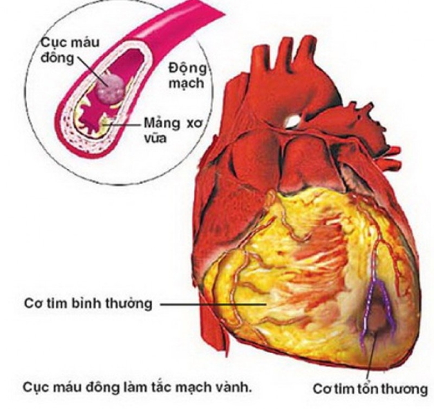 chụp CT có tiêm thuốc cản quang để đánh giá tình trạng hẹp động mạch.