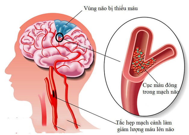 thiếu máu não diễn ra thế nào
