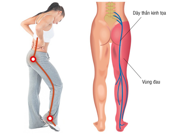 đau thần kinh tọa ở chân