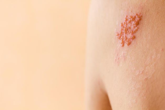 Sau khi khỏi bệnh, virus gây bệnh vẫn còn tồn tại ở rễ dây thần kinh. Hệ thần kinh suy yếu, virus sẽ tái hoạt động và gây ra bệnh Zona thần kinh.