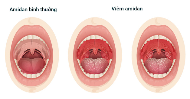 Khi các hạch này đột ngột bị viêm sẽ gây ra những triệu chứng rầm rộ trong thời gian ngắn, gây ra hiện tượng viêm amidan cấp.
