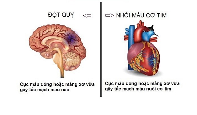 Nhồi máu cơ tim và đột quỵ là 2 bệnh lý khác nhau nhưng nhiều người vẫn nhầm lẫn.