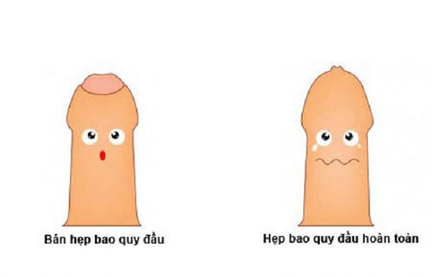 cách chữa hẹp bao quy đầu