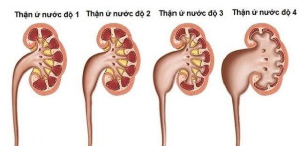 Điều trị sỏi thận ứ nước như thế nào?