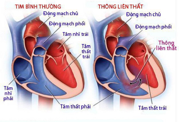 Bệnh tim bẩm sinh sống được bao lâu?