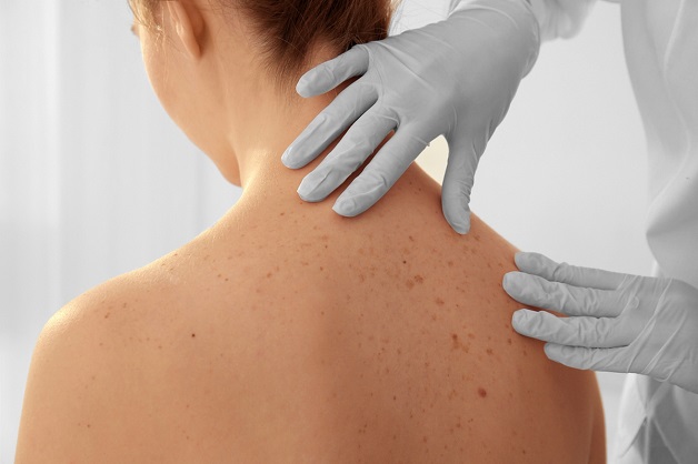 Cách nhận biết dấu hiệu ung thư da