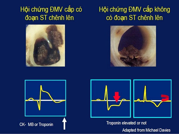 Nhồi máu cơ tim ST chênh lên là gì?