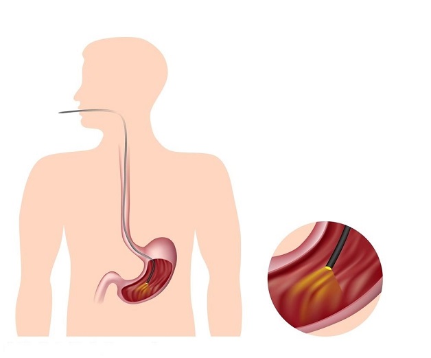 Nội soi tiêu hóa là gì
