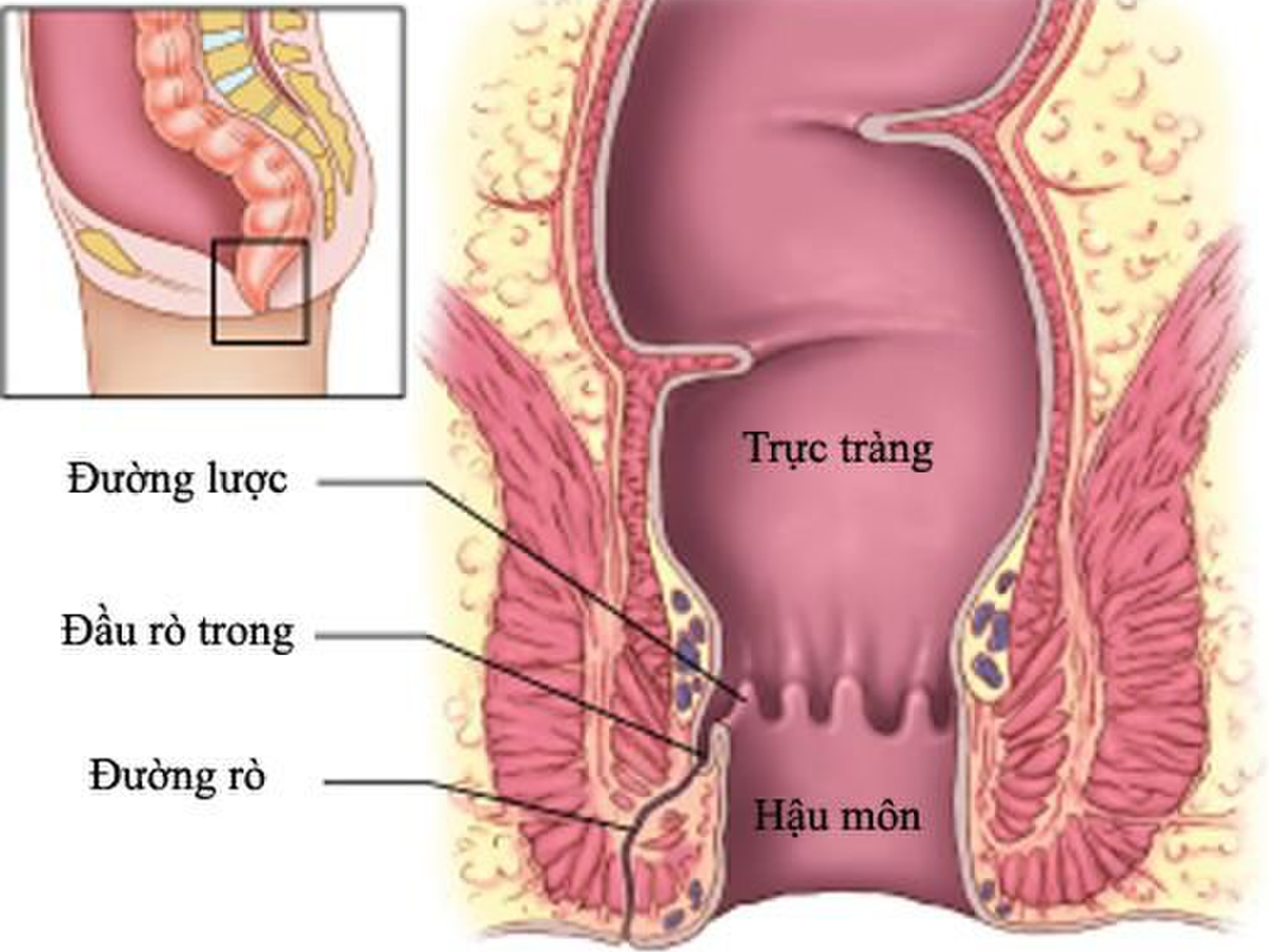 Rò hậu môn là thế nào cần biết