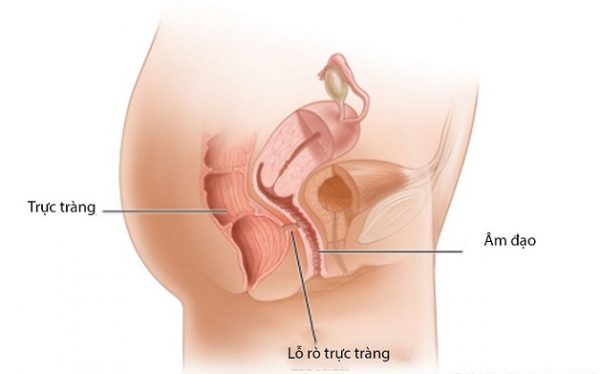 Rò trực tràng là gì?