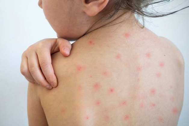 Sởi là căn bệnh nhiều bé gặp phải